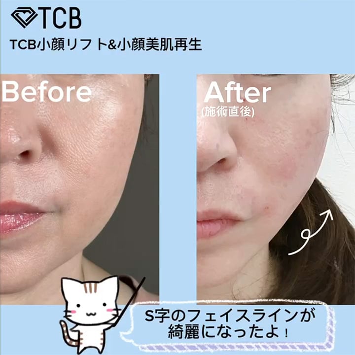 小顔美肌再生の症例写真02