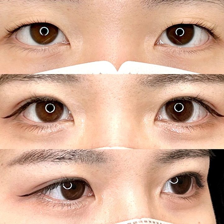 二重埋没の症例写真03