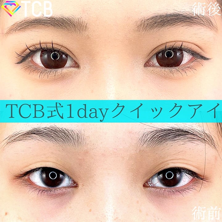二重埋没の症例写真01