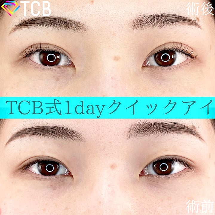 二重埋没の症例写真03