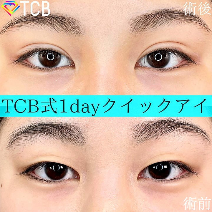 二重埋没の症例写真04