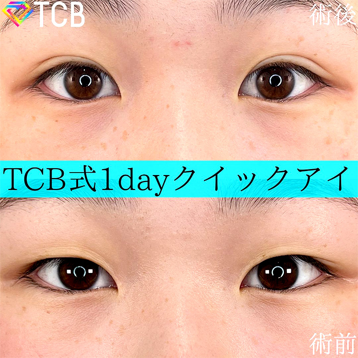 二重埋没の症例写真05