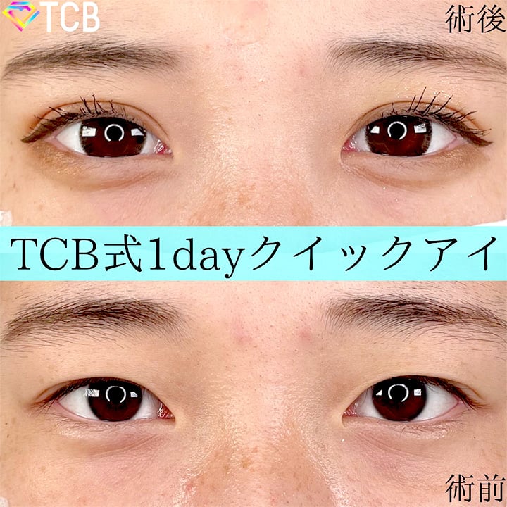 二重埋没の症例写真06