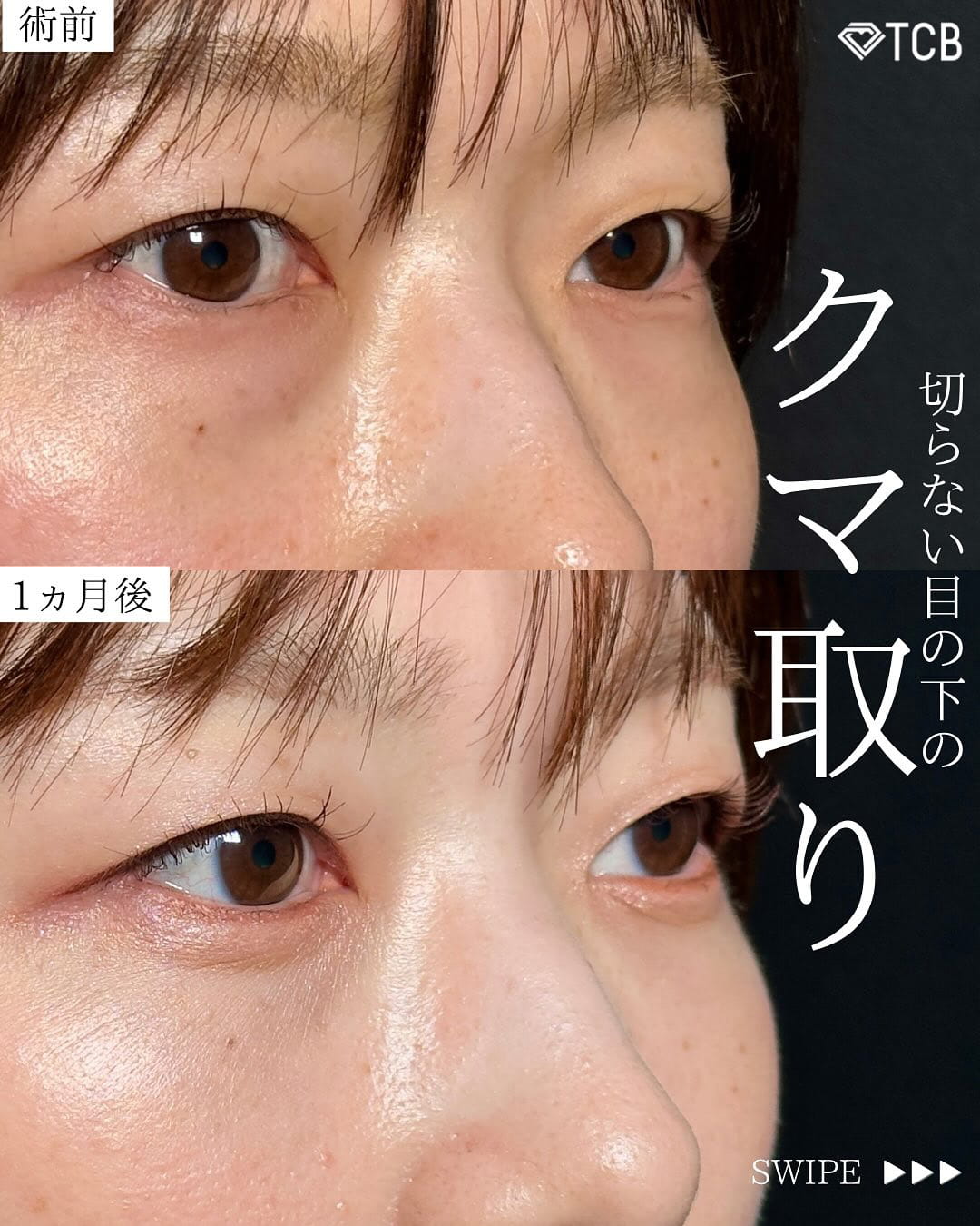 切らない目の下のクマ取り・目の下のたるみ（ふくらみ）取りの症例写真01