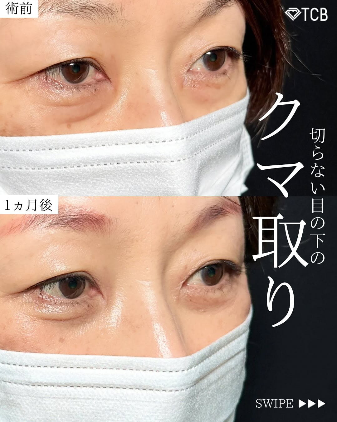 切らない目の下のクマ取り・目の下のたるみ（ふくらみ）取りの症例写真02