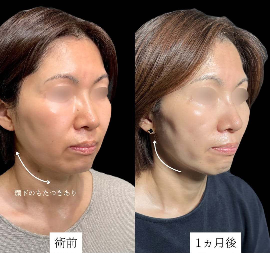 TCB小顔リフトの症例写真01