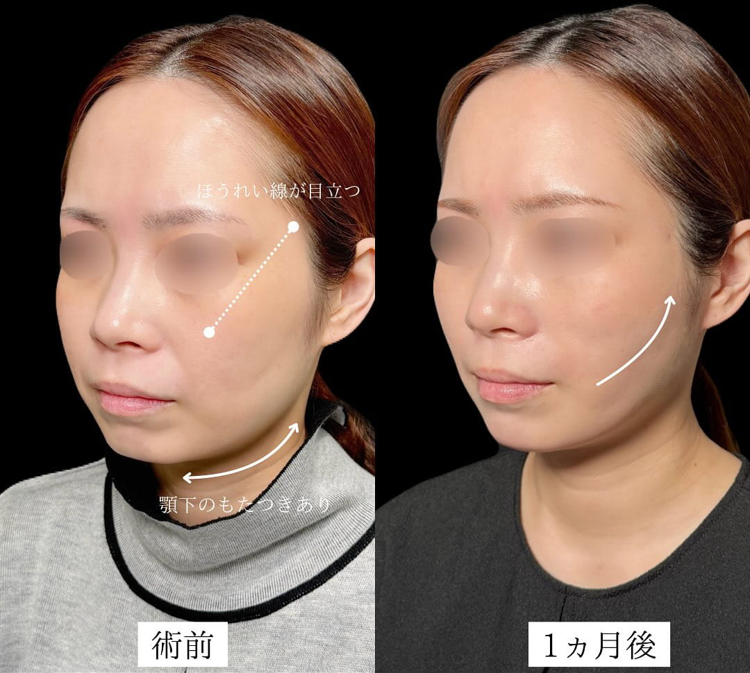 TCB小顔リフトの症例写真02