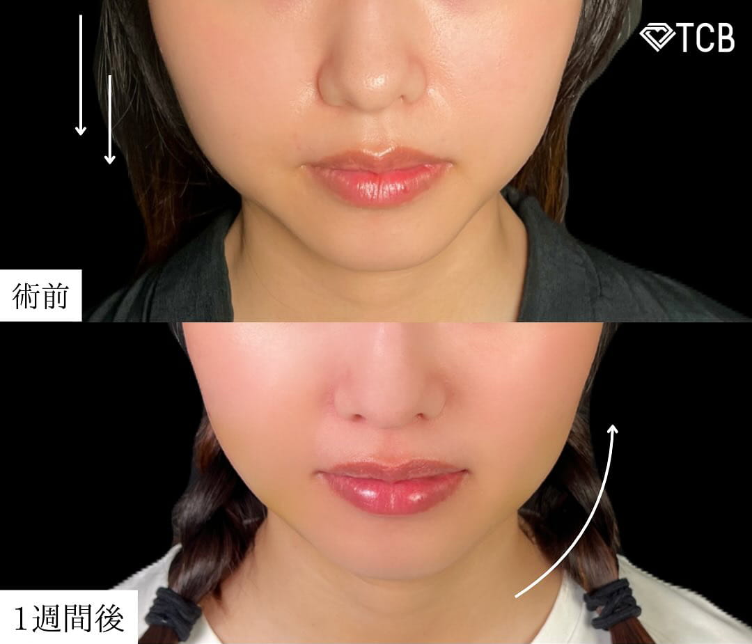 顔の脂肪吸引の症例写真01