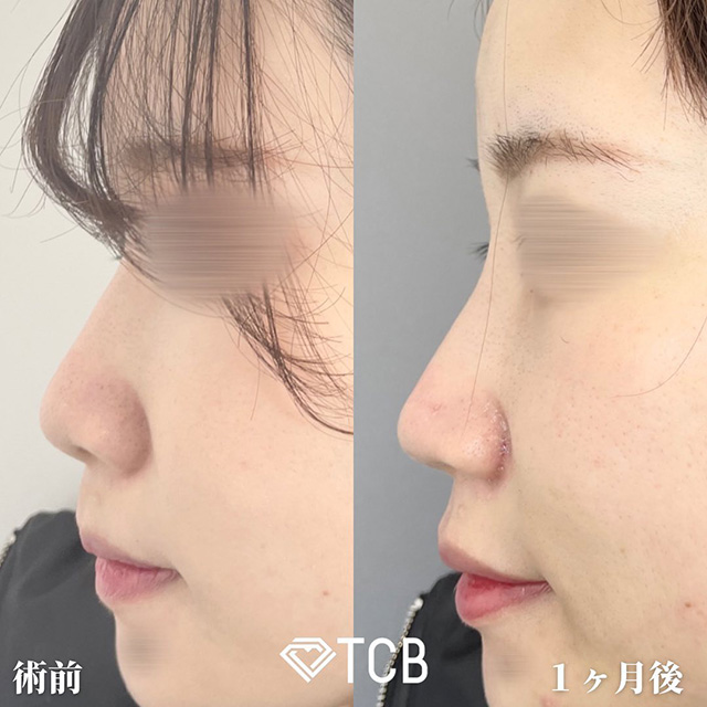 TCB広島院の切開を伴う施術の症例写真01