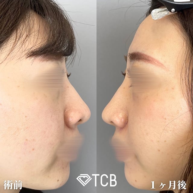 TCB広島院の切開を伴う施術の症例写真02