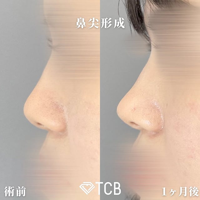 TCB広島院の糸を使用する施術の症例写真01