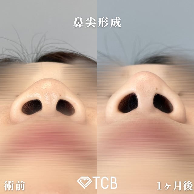 TCB広島院の糸を使用する施術の症例写真02