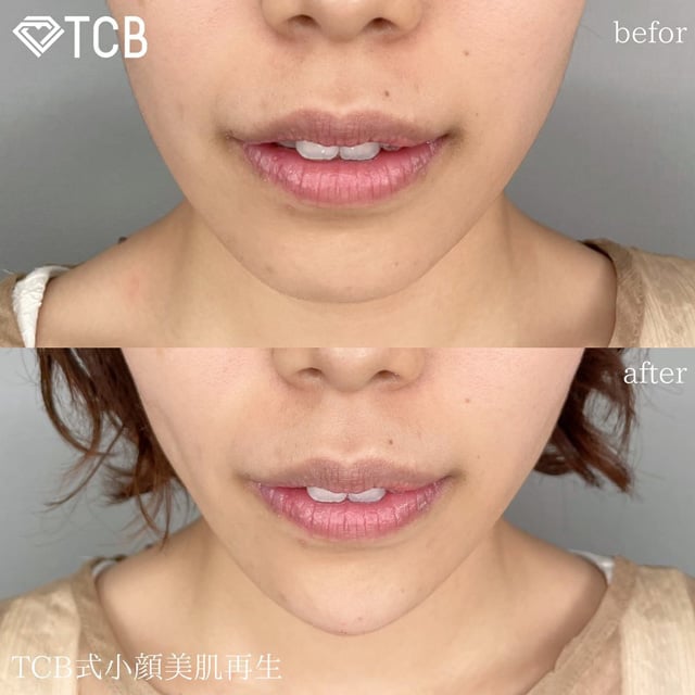 TCB広島院の小顔整形症例写真02