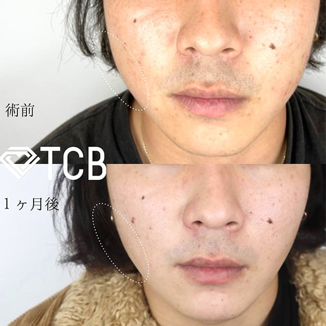 TCB広島院の小顔整形症例写真04