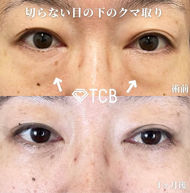 TCB広島院の切らない目の下のクマ取り症例写真01