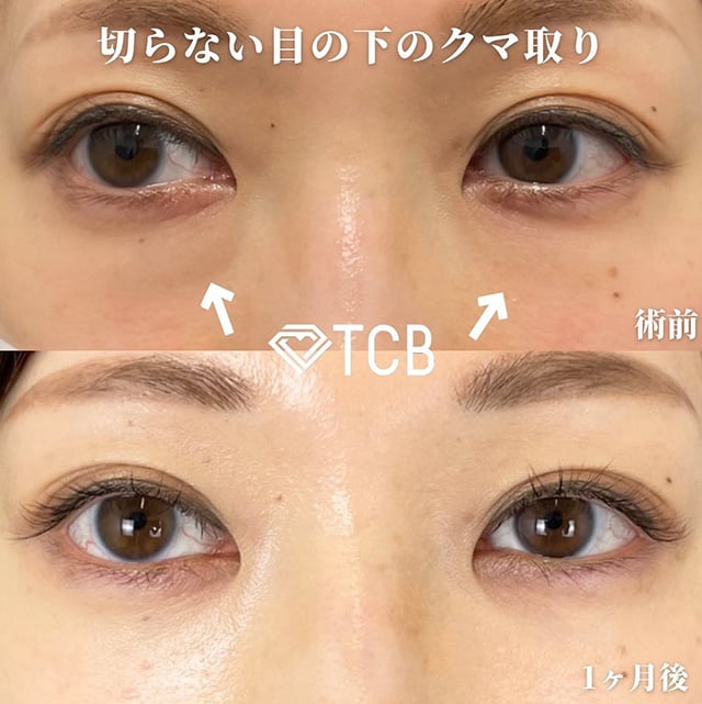 TCB広島院の切らない目の下のクマ取り症例写真02