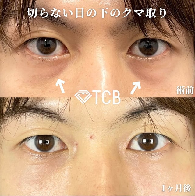 TCB広島院の切らない目の下のクマ取り症例写真03