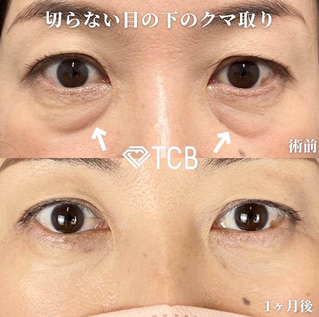 TCB広島院の切らない目の下のクマ取り症例写真04