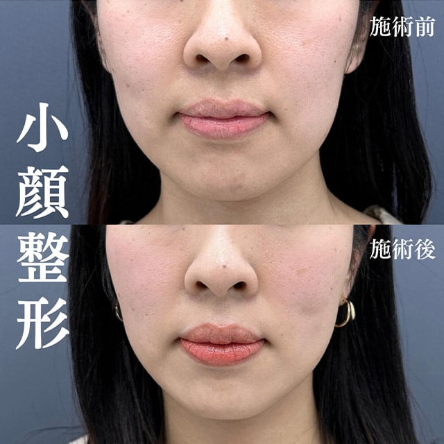 TCB神戸院の小顔美肌再生症例写真01