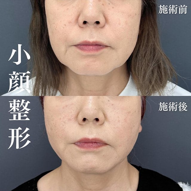 TCB神戸院の小顔美肌再生症例写真02