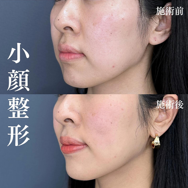 TCB神戸院の糸リフト症例写真01