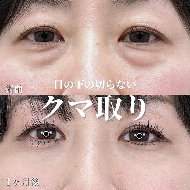 TCB神戸院の切らない目の下のクマ取り症例写真01