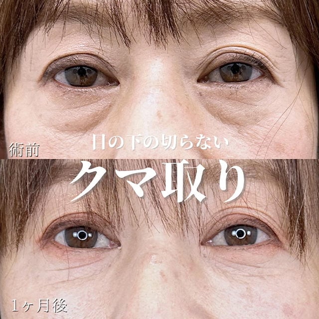 TCB神戸院の切らない目の下のクマ取り症例写真02