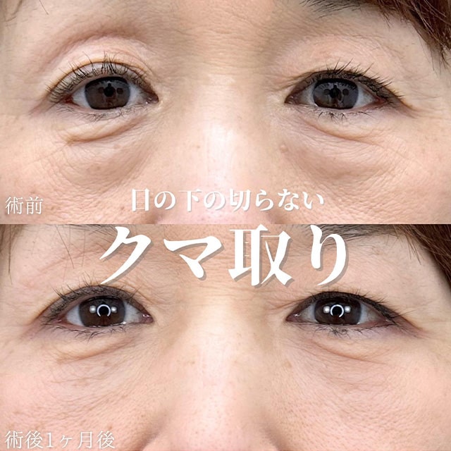 TCB神戸院の切らない目の下のクマ取り症例写真04