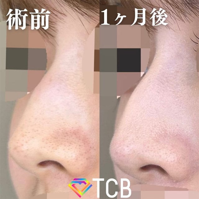 TCB神戸院のTCBメッシュの症例写真01
