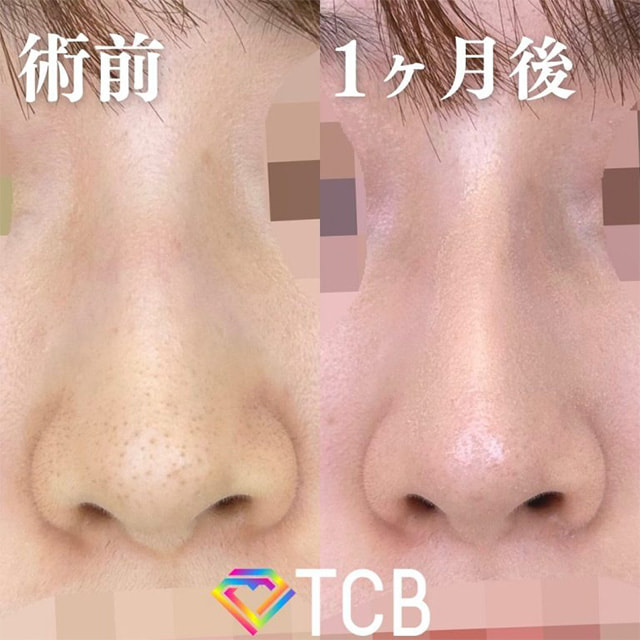 TCB神戸院のTCBメッシュの症例写真02