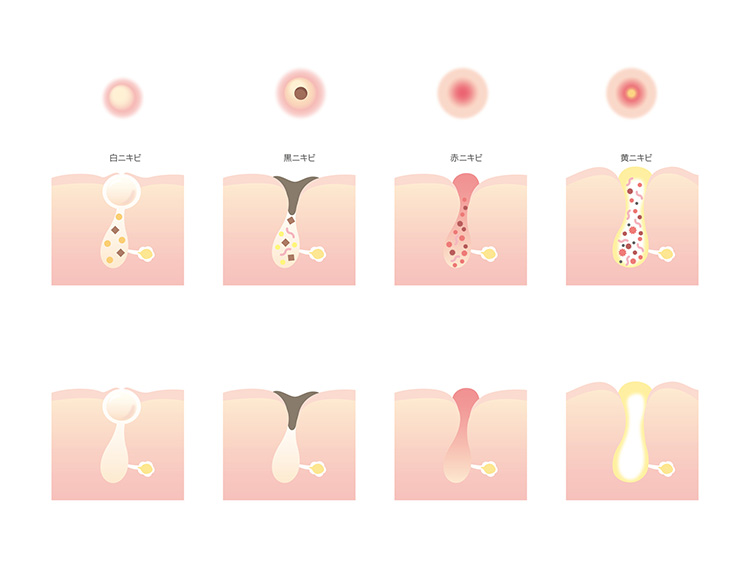 ニキビの種類別 治るまでの期間