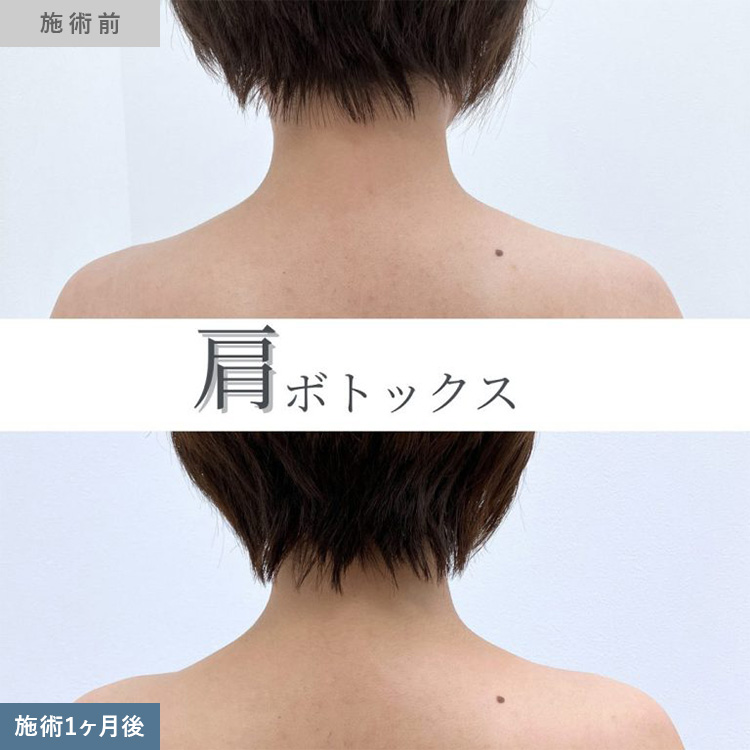 肩こりボトックスの症例写真