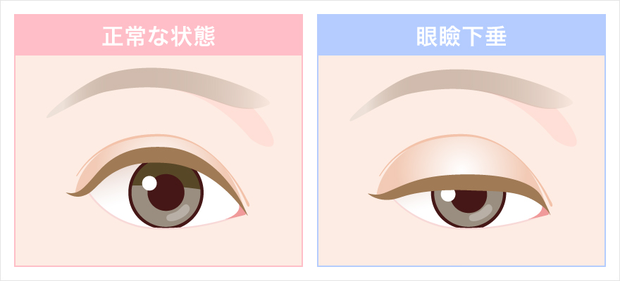 正常な目と眼瞼下垂の目