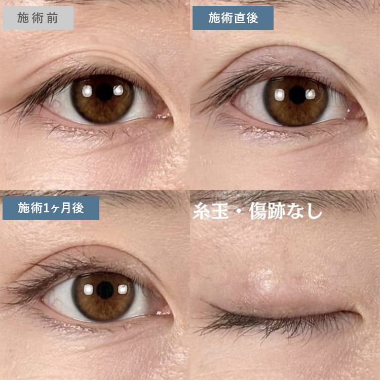 埋没法の症例写真01