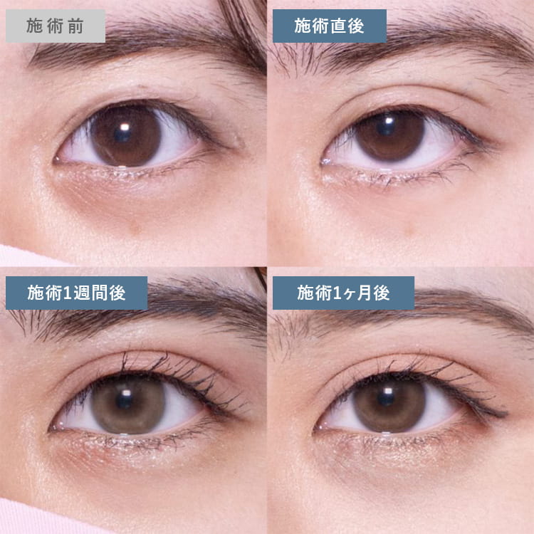 埋没法の症例写真02