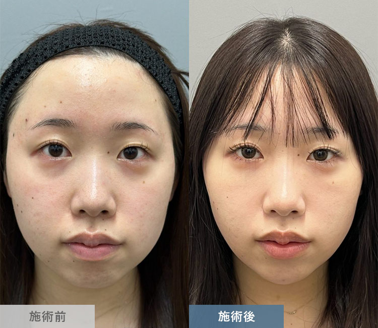 顔の脂肪吸引の症例写真