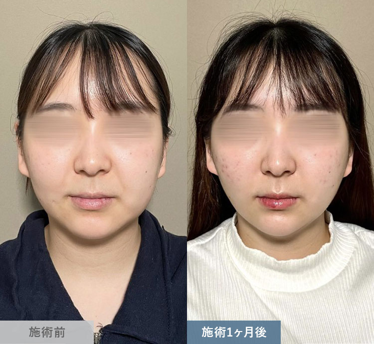 小顔美肌再生（リフトアップ）の症例写真