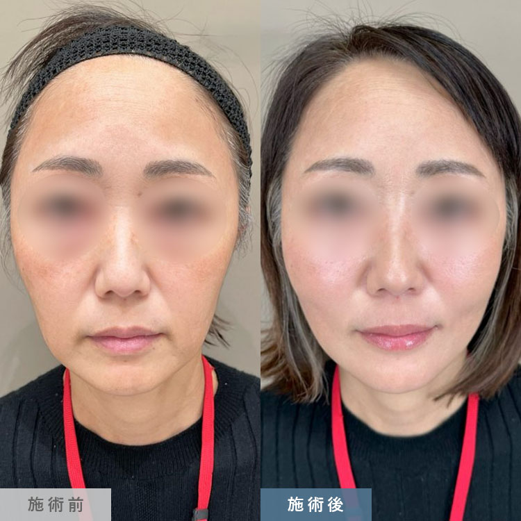 ひょうたん顔を改善した症例写真