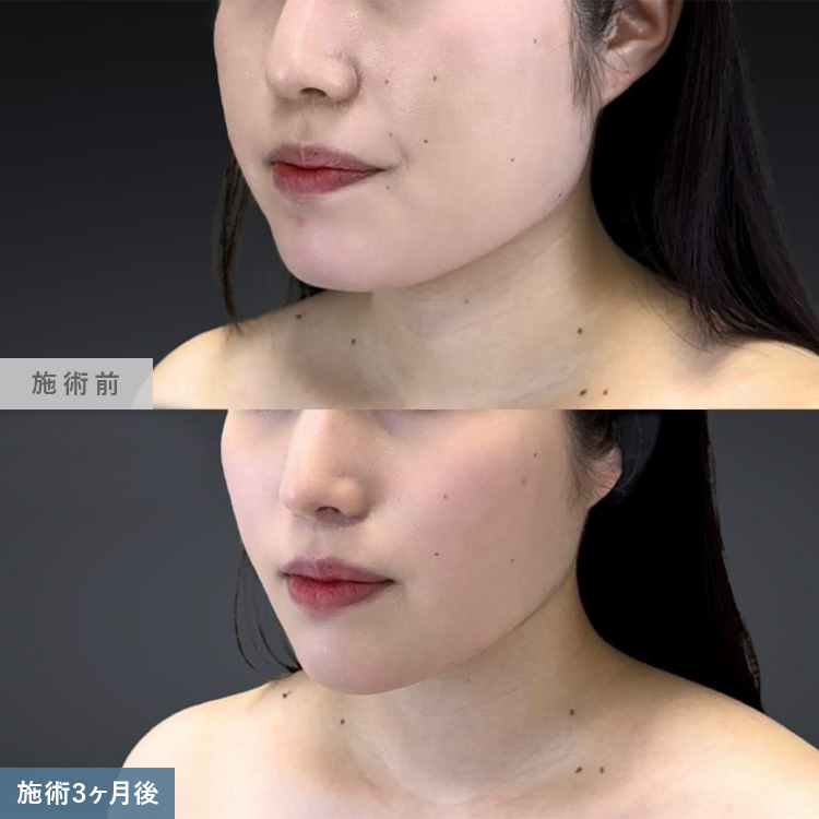 脂肪吸引の症例写真01