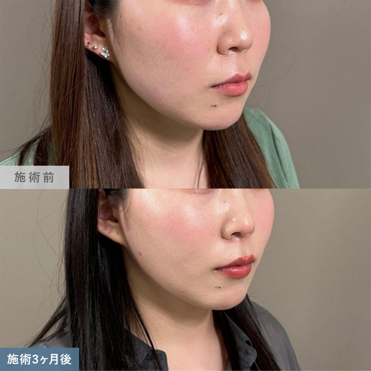 脂肪吸引の症例写真02