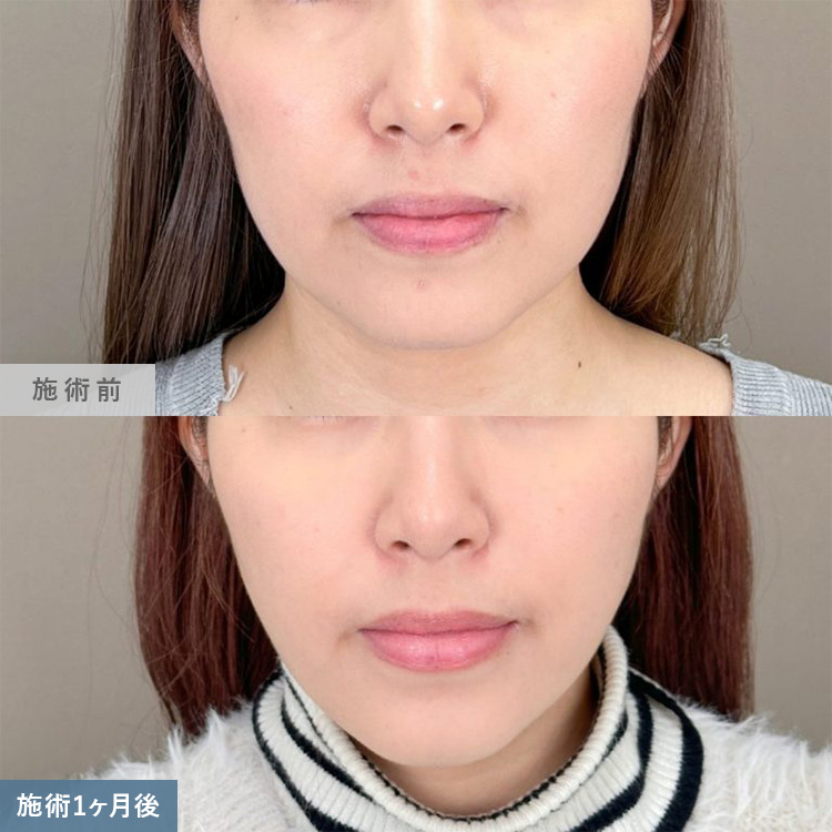 脂肪吸引の症例写真03