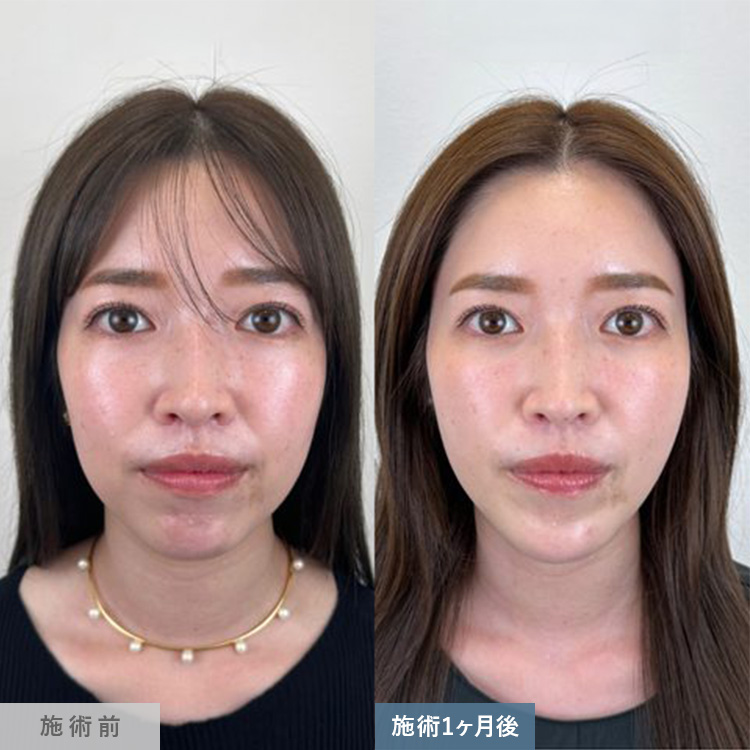脂肪吸引の症例写真04