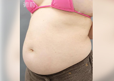 お腹・腰 before メディカルサイズダイエット 症例写真