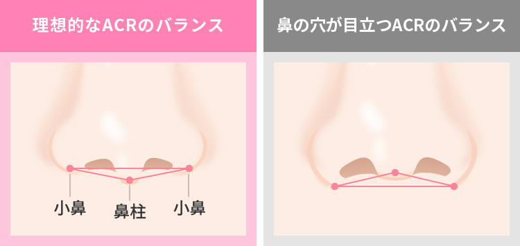 理想的なACRの図解イラスト