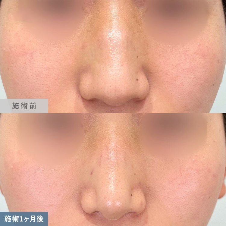 鼻尖形成の症例写真