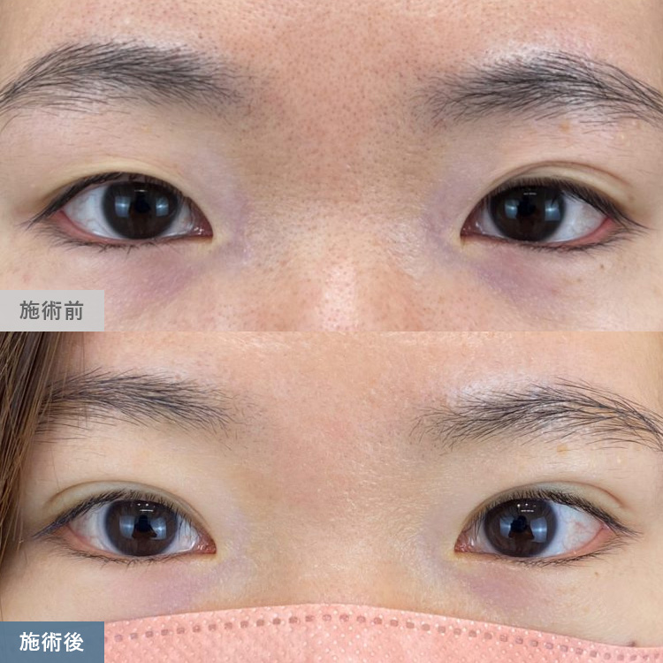 寺西 宏王医師の二重整形の症例写真10
