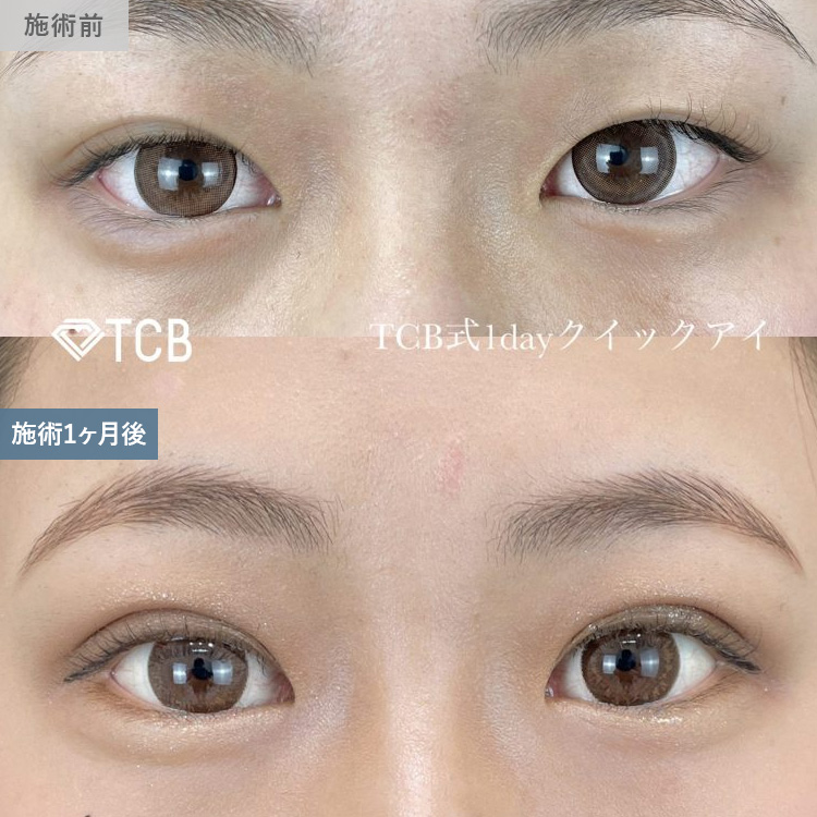 寺西 宏王医師の二重整形の症例写真12