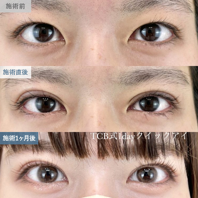 寺西 宏王医師の二重整形の症例写真13