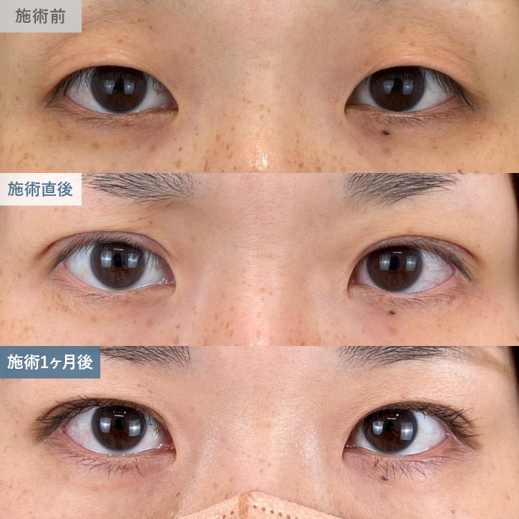 寺西 宏王医師の二重整形の症例写真14