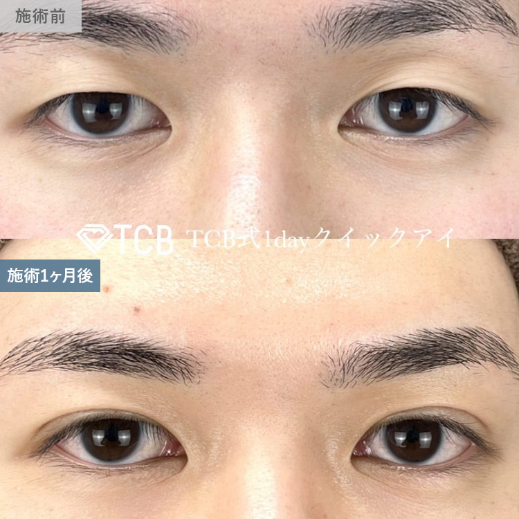 寺西 宏王医師の二重整形の症例写真15